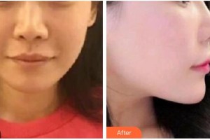 太原晉容整形美容門診部王雅爾整形價(jià)格表附埋線提升案例展示