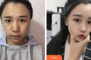 太原晉容整形美容門(mén)診部王亞琪整形價(jià)格表附超聲提拉案例展示