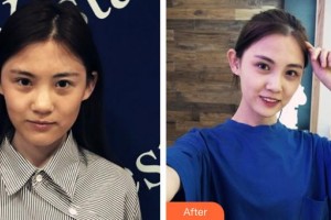 太原晉容整形美容門(mén)診部姜春生整形價(jià)格表附超聲提拉案例展示