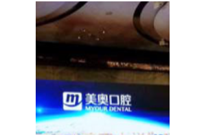 長沙美萊整容醫(yī)院好么  假體隆鼻果分享案例果圖