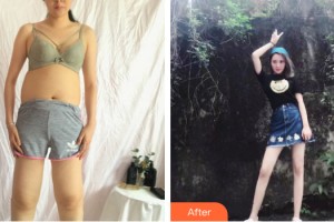 柳州仁美整形美容外科診所黃金龍整形價格表附大腿吸脂案例展示