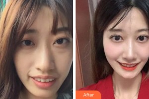 貴陽利美康醫(yī)院唐明星整形價格表附牙齒矯正案例展示