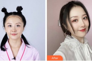 貴陽利美康醫(yī)院汪國應(yīng)整形價格表附植發(fā)案例展示