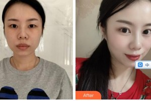 太原晉綺醫(yī)療美容診所蘇育臺(tái)整形價(jià)格表附眼部綜合案例展示