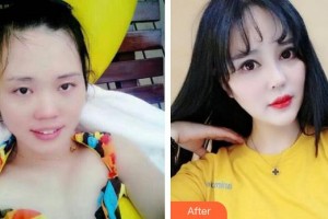 太原時(shí)光整形美容醫(yī)院杜凱娟整形價(jià)格表附眼部綜合案例展示