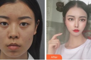 太原美媛薈整形美容醫(yī)院陳霆璋整形價格表附埋線提升案例展示