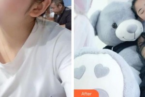 太原華美整形美容醫(yī)院李霞整形價格表附埋線提升案例展示