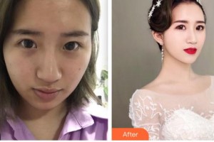 太原軍大醫(yī)療美容醫(yī)院楊俊斐整形價格表附埋線提升案例展示