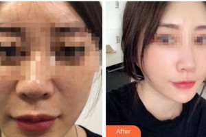 太原星范醫(yī)療美容門診部魏星整形價格表附埋線提升案例展示