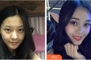 太原星范醫(yī)療美容門診部嚴健頻整形價格表附埋線提升案例展示