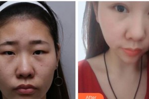 太原晉綺醫(yī)療美容診所簡銘成整形價格表附眼部綜合案例展示