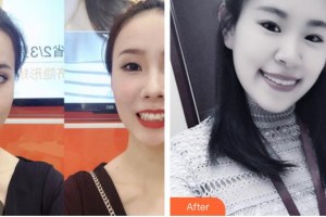 太原晉綺醫(yī)療美容診所洪欣瑜整形價格表附下瞼整形案例展示