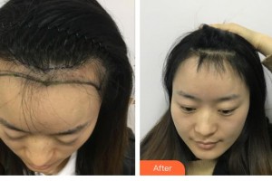 太原顯微手外科醫(yī)院毛發(fā)移植中心李愚炅整形價格表附種植發(fā)際線案例展示