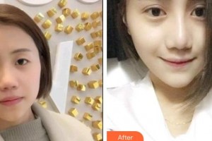 太原愛爾眼科醫(yī)院高海英整形價格表附切開雙眼皮案例展示