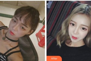 太原華美整形美容醫(yī)院趙亞峰整形價(jià)格表附切開雙眼皮案例展示