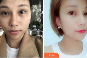 太原麗都整形美容醫(yī)院王同坡整形價(jià)格表附埋線提升案例展示