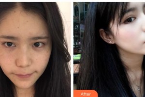 太原麗都整形美容醫(yī)院趙霞整形價(jià)格表附激光美膚激光案例展示