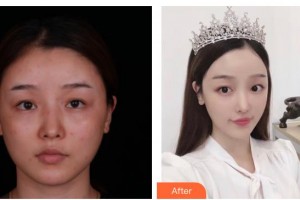 太原軍大醫(yī)療美容醫(yī)院楊祥勝整形價(jià)格表附鼻部綜合案例展示