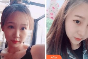 太原時(shí)光整形美容醫(yī)院李晨霞整形價(jià)格表附鼻部綜合案例展示