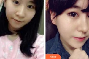 太原麗都整形美容醫(yī)院楊順新院長整形價(jià)格表附鼻部綜合案例展示