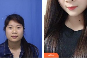 太原華美整形美容醫(yī)院張鵬云整形價(jià)格表附定點(diǎn)雙眼皮案例展示