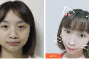 太原愛爾眼科醫(yī)院朱彬整形價(jià)格表附定點(diǎn)雙眼皮案例展示