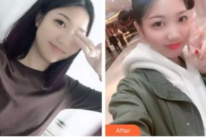 太原愛爾眼科醫(yī)院梁娟整形價(jià)格表附切開雙眼皮案例展示