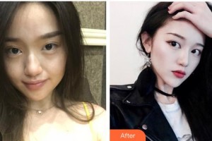 太原時(shí)光整形美容醫(yī)院張國(guó)軍整形價(jià)格表附埋線提升案例展示