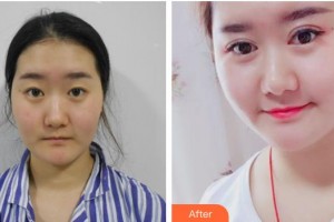 太原星范醫(yī)療美容門診部徐凱整形價(jià)格表附眼部綜合案例展示