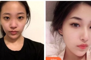 大同美神整形美容醫(yī)院王賀宇整形價(jià)格表附鼻部綜合案例展示