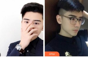 大同鳳凰婦產(chǎn)醫(yī)院整形美容科張昕整形價(jià)格表附鼻部綜合案例展示