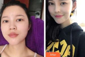 大同市第二人民醫(yī)院整形燒傷外科邢松山整形價(jià)格表附鼻部綜合案例展示