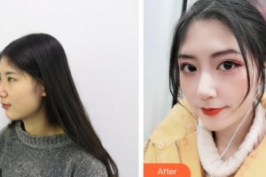 大同魅力舍賓美容診所張斌整形價(jià)格表附鼻部綜合案例展示