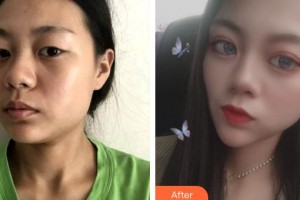 大同市第五人民醫(yī)院乳腺整形科睢瑞和整形價(jià)格表附埋線(xiàn)提升案例展示