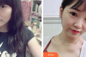 大同清木整形醫(yī)院崔虎院長(zhǎng)整形價(jià)格表附埋線(xiàn)提升案例展示