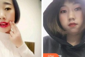 大同美神整形美容醫(yī)院王東整形價(jià)格表附根管調(diào)節(jié)案例展示