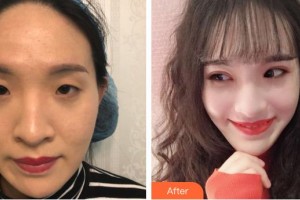 大同清木整形醫(yī)院朱東磊整形價(jià)格表附眼部綜合案例展示