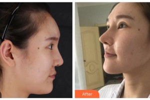 陽(yáng)泉美亞醫(yī)療美容診所邢藝?yán)_整形價(jià)格表附肋軟骨隆鼻案例展示