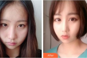 陽(yáng)泉煤業(yè)集團(tuán)總醫(yī)院整形美容科岳瑞香整形價(jià)格表附鼻部綜合案例展示