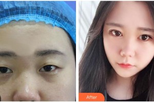 長治天成醫(yī)療美容診所郭妍整形價格表附定點(diǎn)雙眼皮案例展示