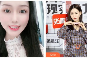 長治億大口腔醫(yī)院趙喜聰整形價格表附隱形托槽矯正案例展示