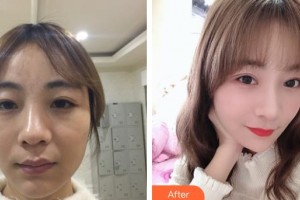 晉城星范醫(yī)療美容診所林赫院長整形價格表附眼部修復(fù)案例展示