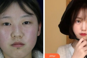 晉城鳳凰整形美容醫(yī)院尹琥珠整形價(jià)格表附開(kāi)內(nèi)眼角案例展示