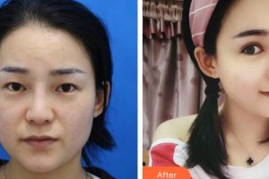 晉城星范醫(yī)療美容診所崔雅寧整形價(jià)格表附眼部綜合案例展示