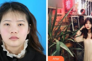 晉城市眼科醫(yī)院韋云艷整形價(jià)格表附眼部綜合案例展示