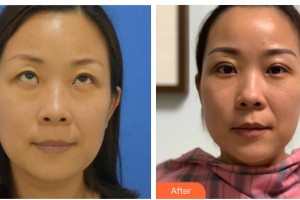 晉城俏麗醫(yī)療美容門(mén)診部趙利慶整形價(jià)格表附切開(kāi)雙眼皮案例展示