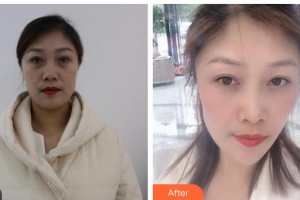 晉城俏麗醫(yī)療美容門(mén)診部杜銀燕整形價(jià)格表附眼部綜合案例展示