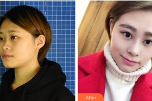 晉中鷹華眼科醫(yī)院馬自勤整形價(jià)格表附切開(kāi)雙眼皮案例展示