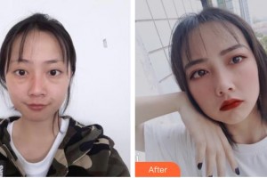 晉中鷹華眼科醫(yī)院韓俊先整形價格表附上眼瞼去脂案例展示