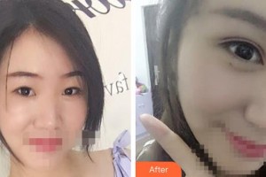 晉中鷹華眼科醫(yī)院惠延年整形價格表附眼部綜合案例展示